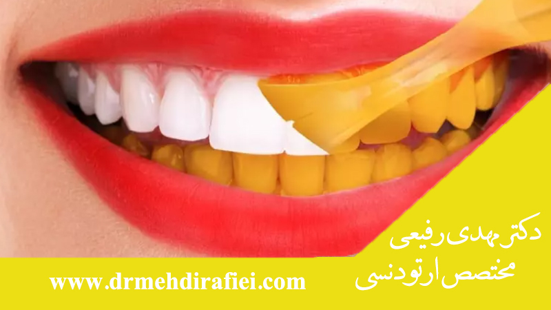 درمان خانگی زردی دندان