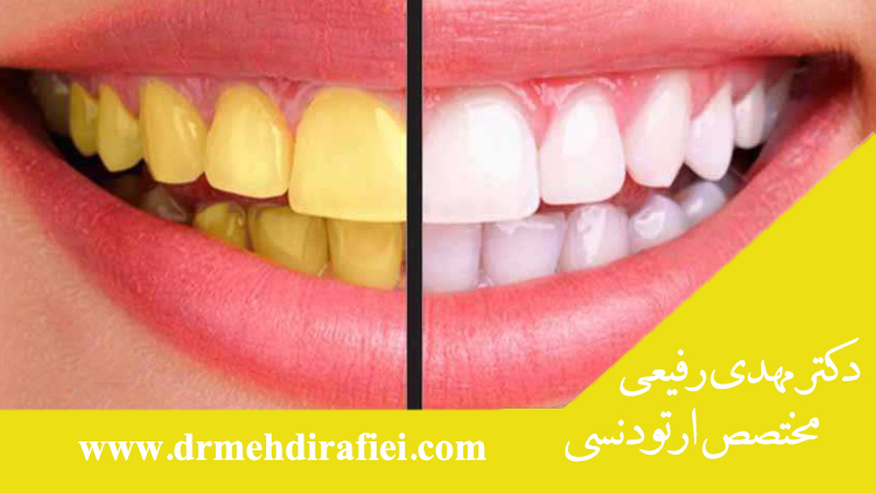 درمان زردی دندان چیست؟