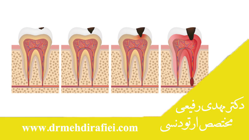 کرم‌ خوردگی دندان