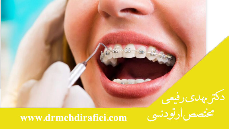 چه افرادی به ارتودنسی نیاز دارند؟