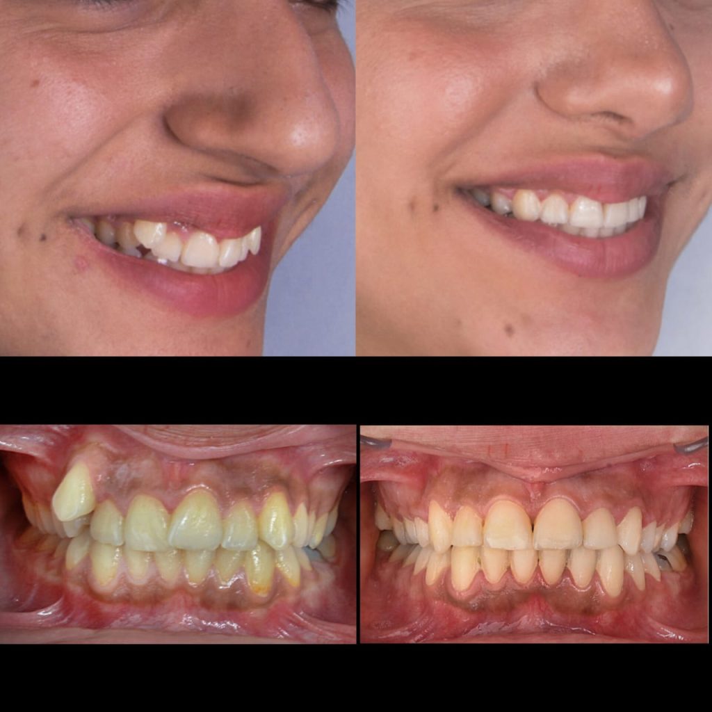 نمونه کار ارتودنسی دکتر مهدی رفیعی متخصص ارتودنسی اصفهان