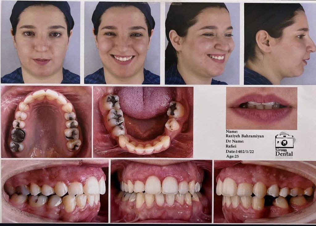 نمونه کار ارتودنسی دکتر مهدی رفیعی متخصص ارتودنسی اصفهان