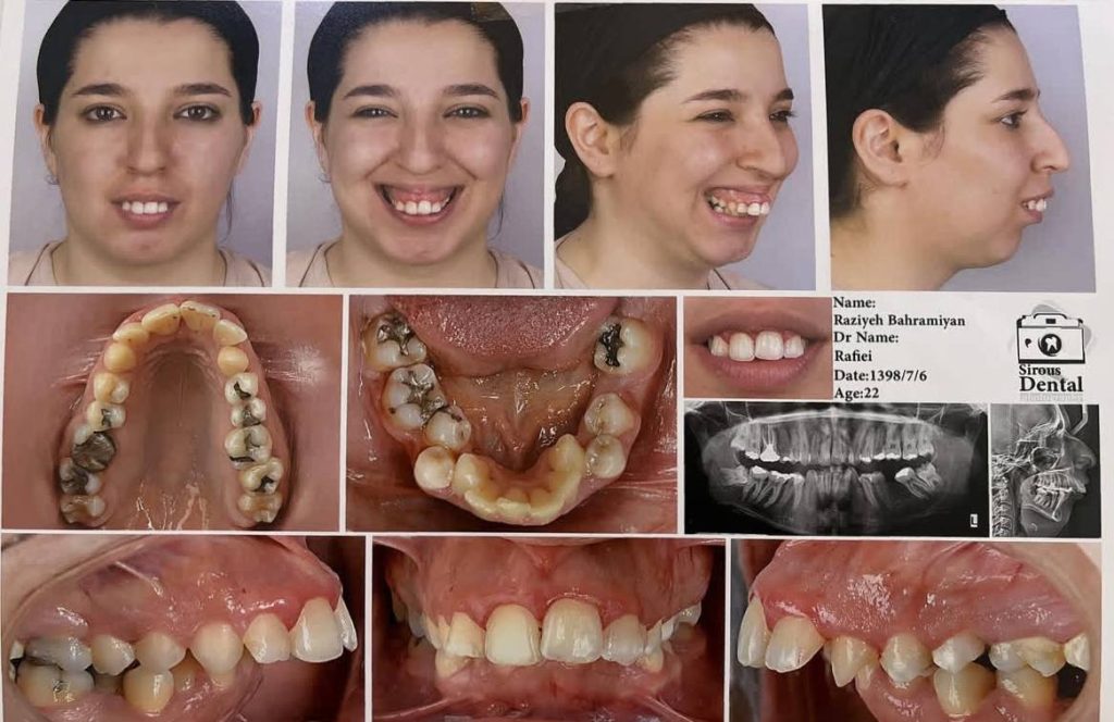 نمونه کار ارتودنسی دکتر مهدی رفیعی متخصص ارتودنسی اصفهان