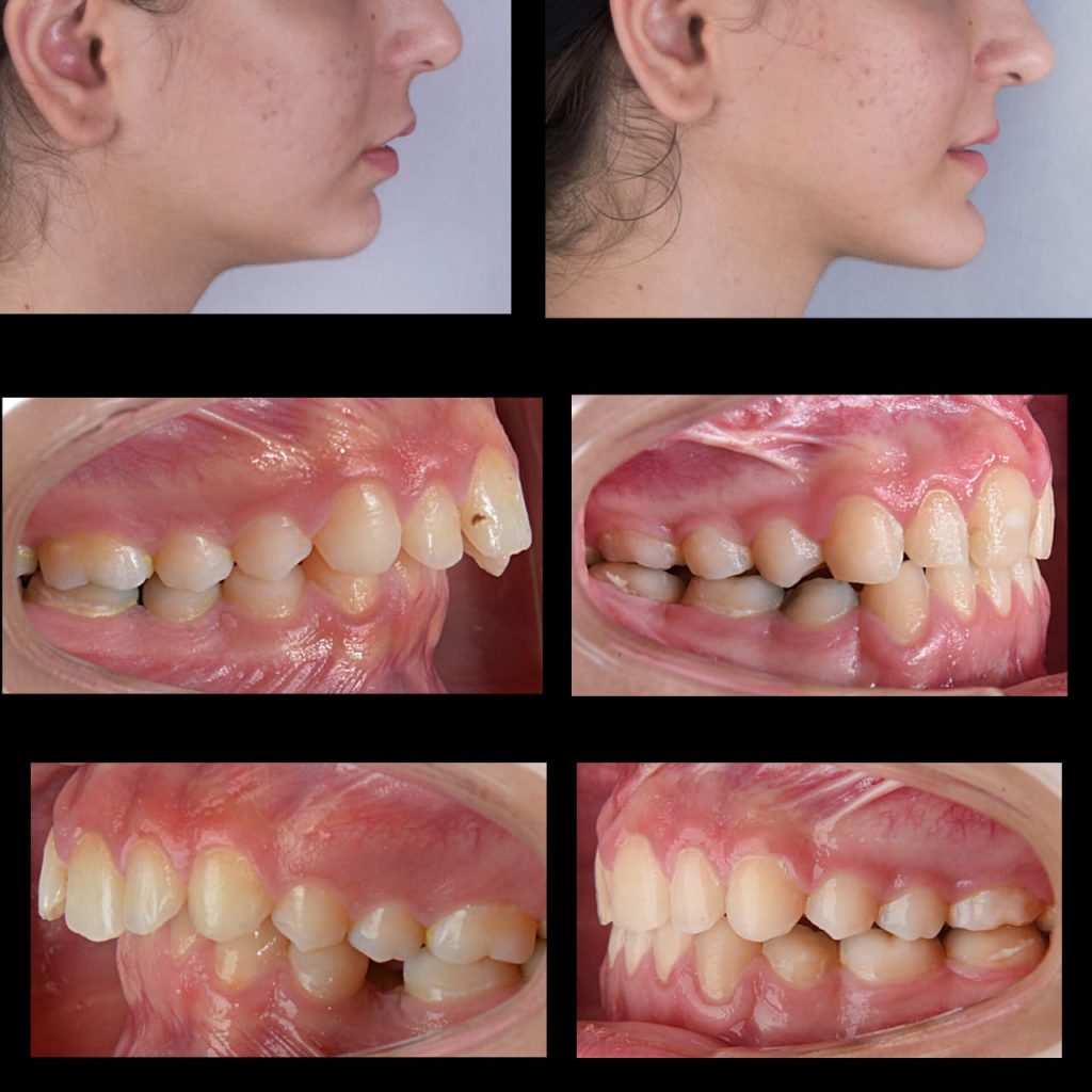 نمونه کار ارتودنسی دکتر مهدی رفیعی متخصص ارتودنسی اصفهان