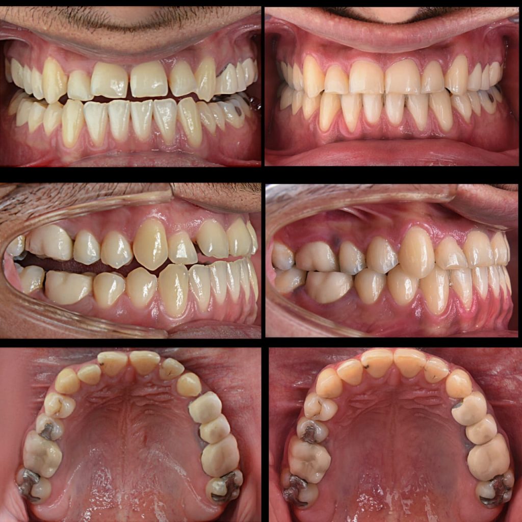 نمونه کار ارتودنسی دکتر مهدی رفیعی متخصص ارتودنسی اصفهان