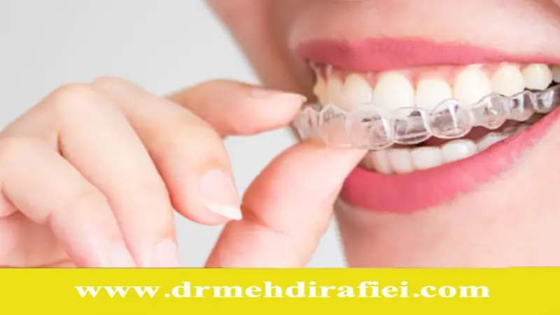 چالش‌های نگهداری ارتودنسی نامرئی