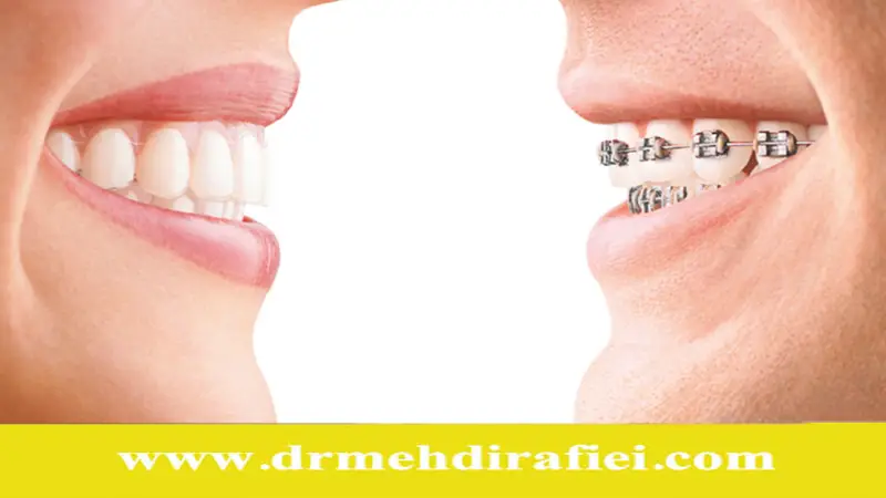مقایسه ارتودنسی نامرئی و سنتی