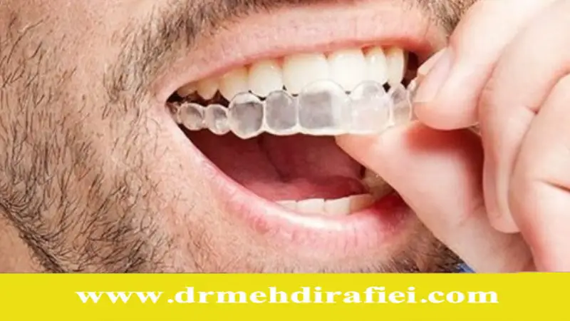 مزایا و معایب اینویزالاین