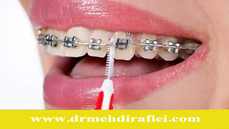 نکات مراقبتی در طول درمان ارتودنسی
