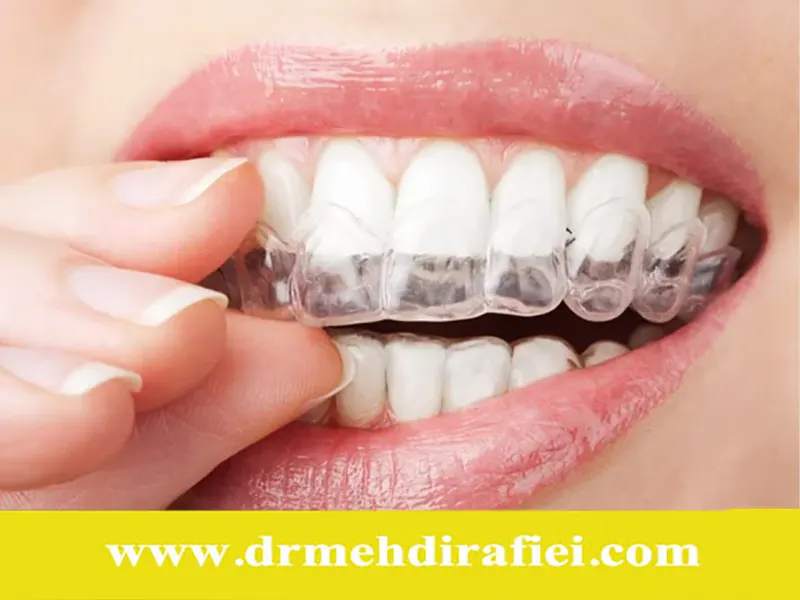 ارتودنسی دیجیتال چیست و چگونه انجام می‌شود؟