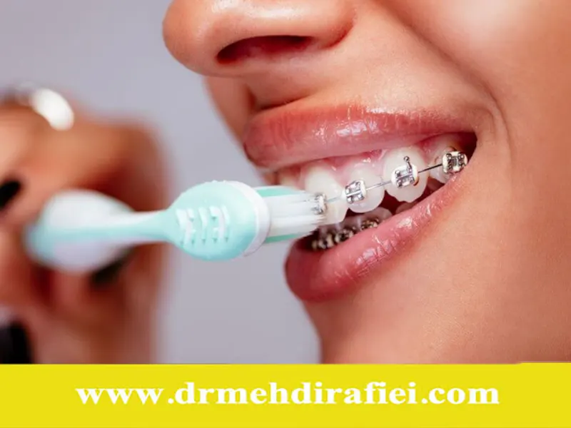 مسواک زدن صحیح هنگام استفاده از ارتودنسی