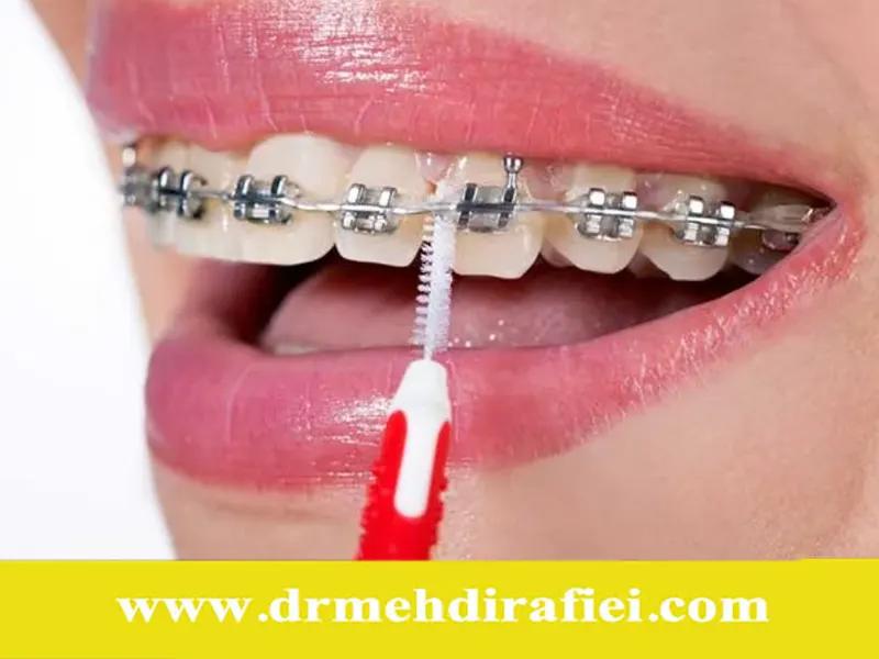 چگونه از دستگاه‌های ارتودنسی خود مراقبت کنیم؟