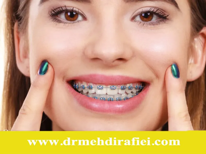 ارتودنسی در افراد دارای دندان‌های حساس