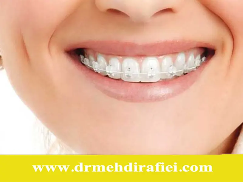 چالش‌های رایج بیماران در دوران ارتودنسی