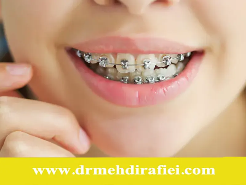 چه عواملی درمان ارتودنسی را طولانی‌تر می‌کند؟