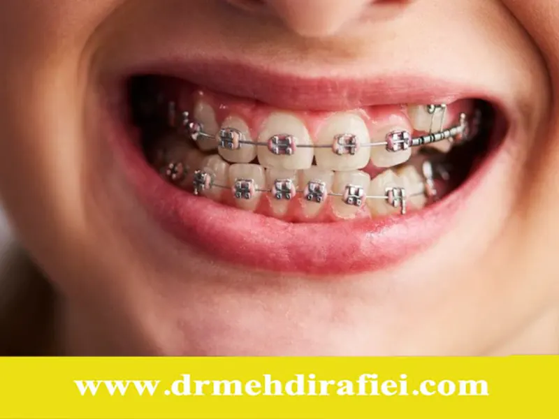 چگونه از لق شدن دندان‌ها در طول ارتودنسی جلوگیری کنیم؟