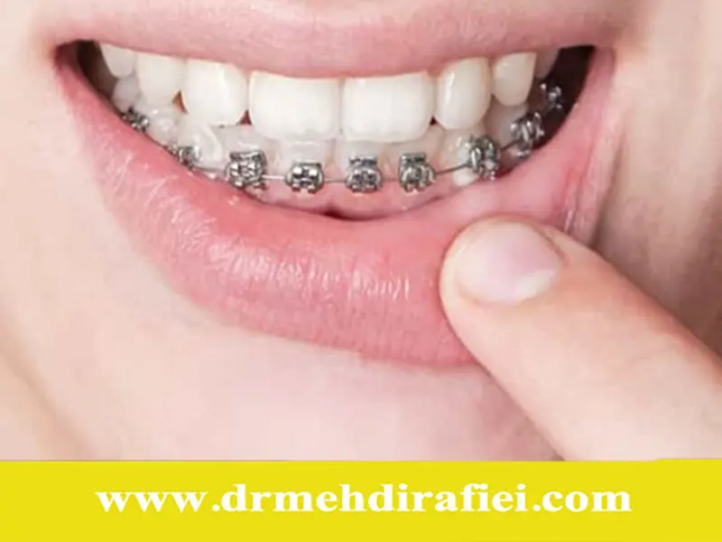 آیا ارتودنسی ارزش زمان و هزینهاش را دارد؟