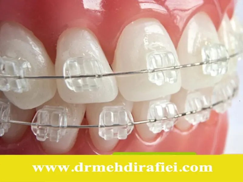 چگونه دندانهای ارتودنسیشده را درخشان نگه داریم؟