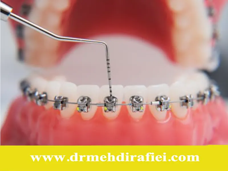 توصیههای پس از نصب بریسهای ارتودنسی