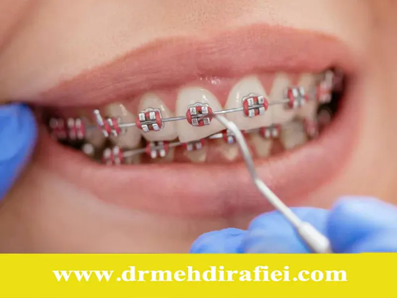 آیا ارتودنسی باعث تغییر فرم صورت می‌شود؟