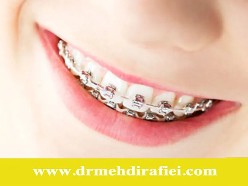 طول عمر بریس‌های ارتودنسی