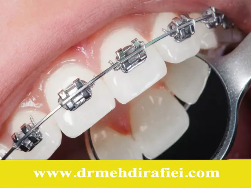 چگونه ارتودنسی به اصلاح لبخند لثه‌ای کمک می‌کند؟