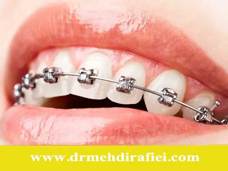 آیا پس از ارتودنسی دندان‌ها نیاز به نگهدارنده دارند؟