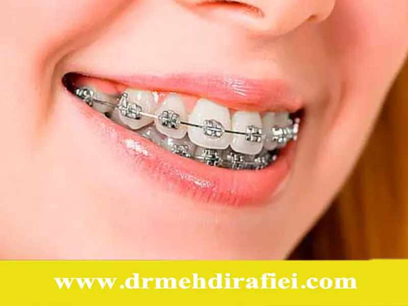 تأثیر ارتودنسی بر سینوس‌ها