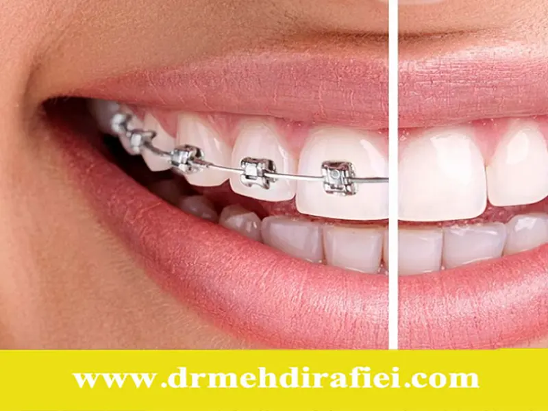 نقش والدین در موفقیت درمان ارتودنسی کودکان