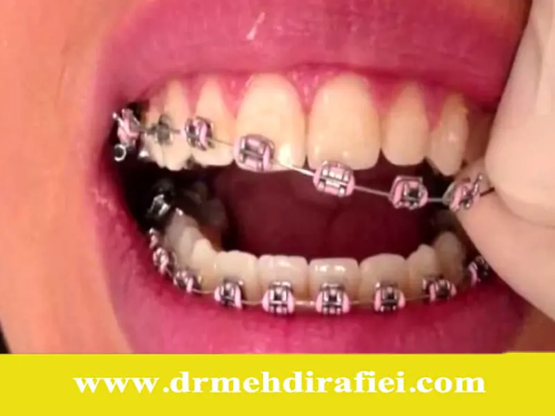 معایب احتمالی ارتودنسی و راهکارهای جلوگیری از آن