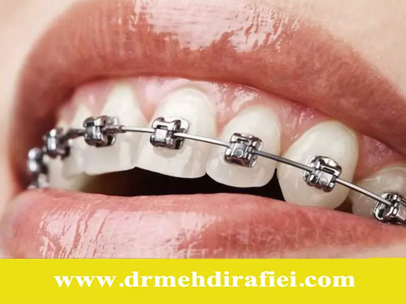 مشکلات ارتودنسی در کودکان