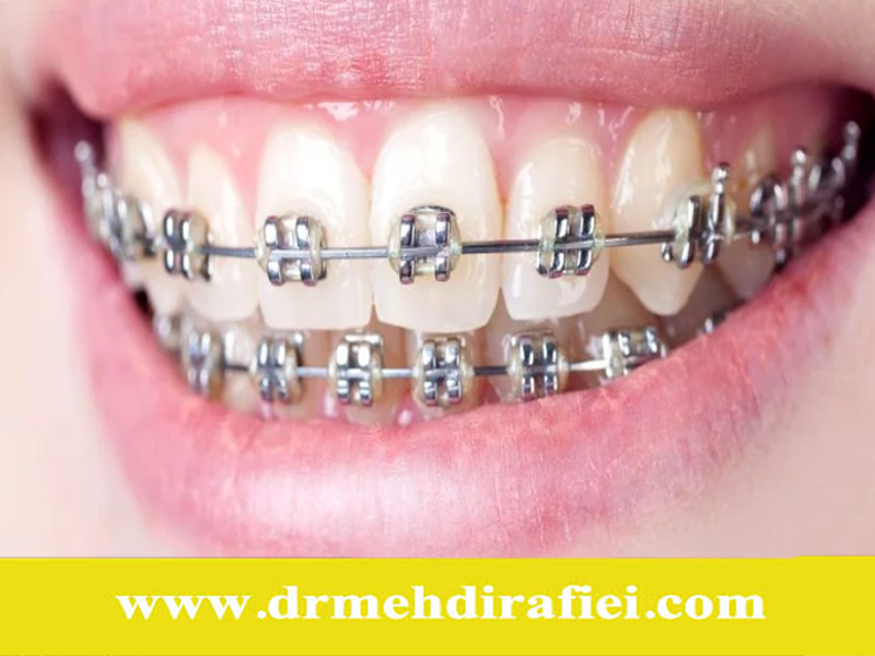 چگونه از آسیب‌دیدگی دستگاه‌های ارتودنسی جلوگیری کنیم