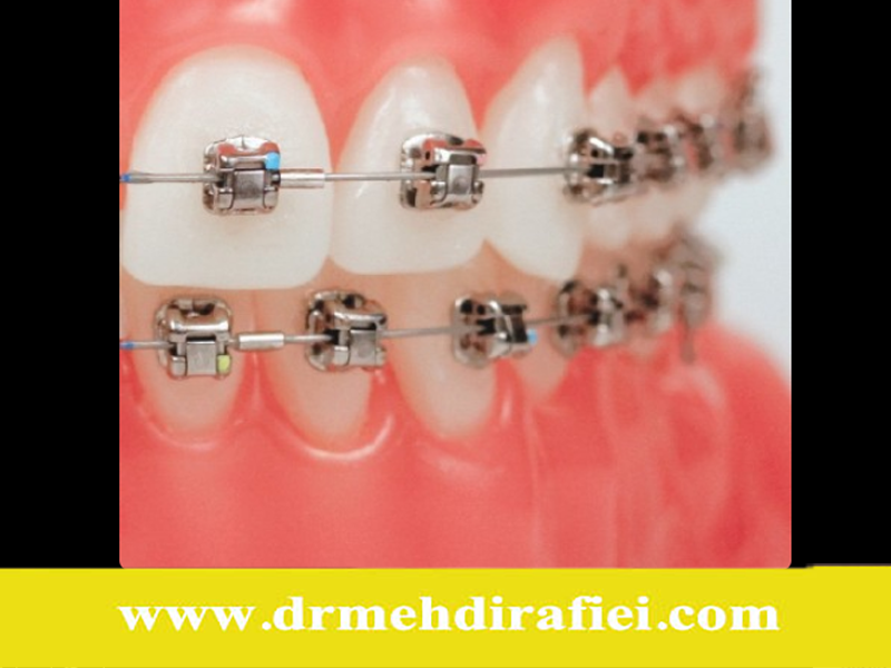 تأثیر ارتودنسی بر اعتمادبه‌نفس
