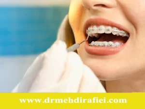 ارتودنسی و ایمپلنت