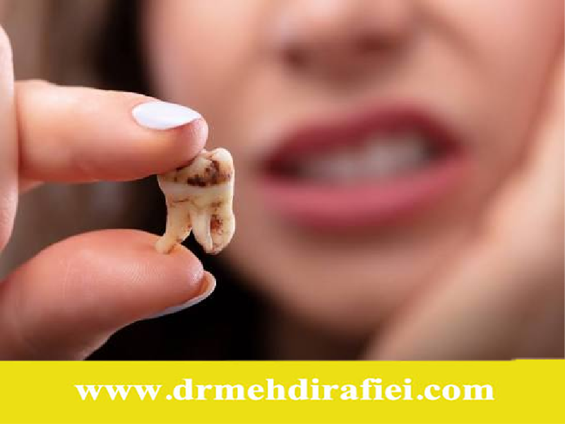 علل اصلی پوسیدگی دندان