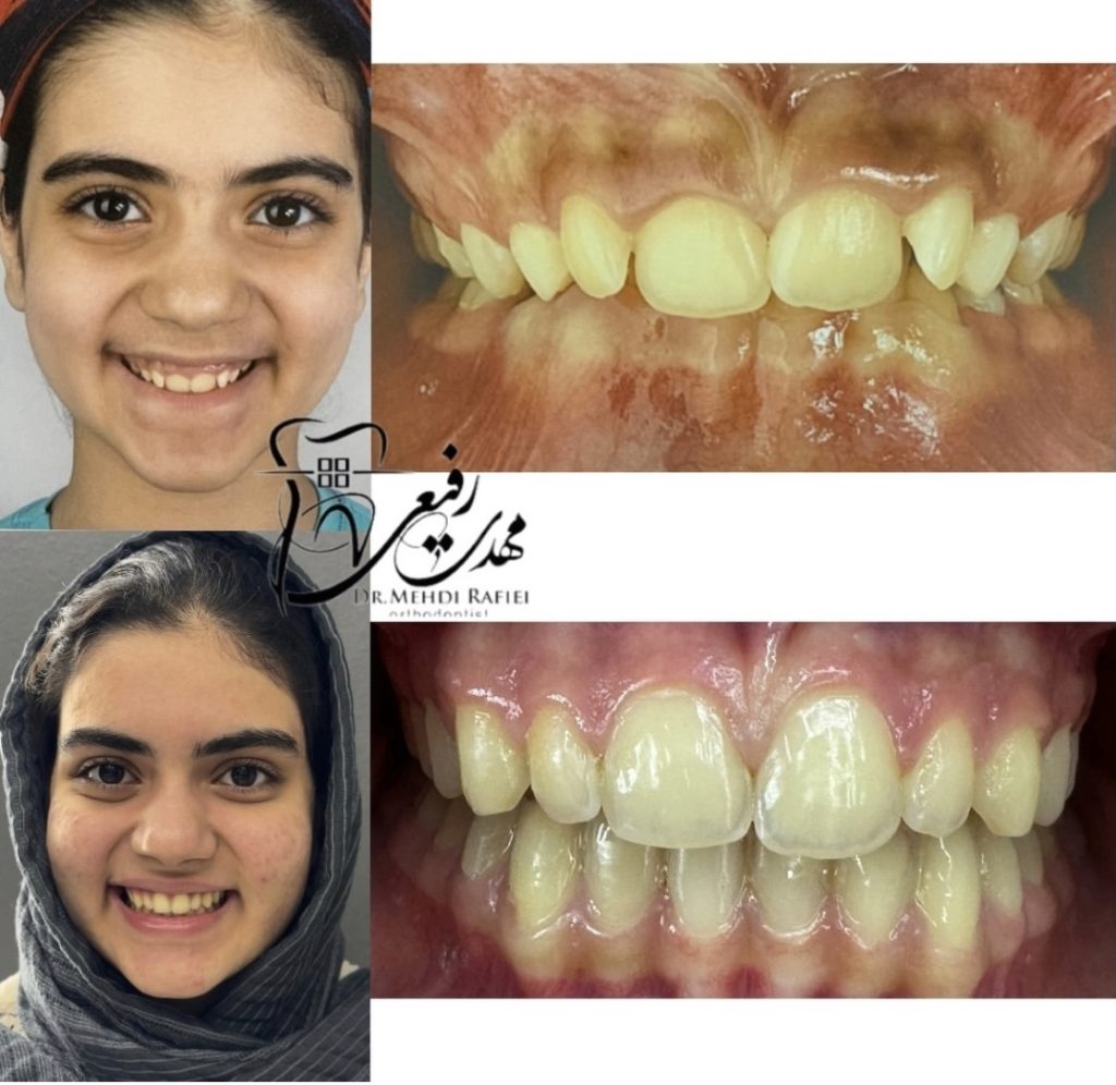 نمونه کار متخصص ارتودنسی اصفهان دکتر مهدی رفیعی
