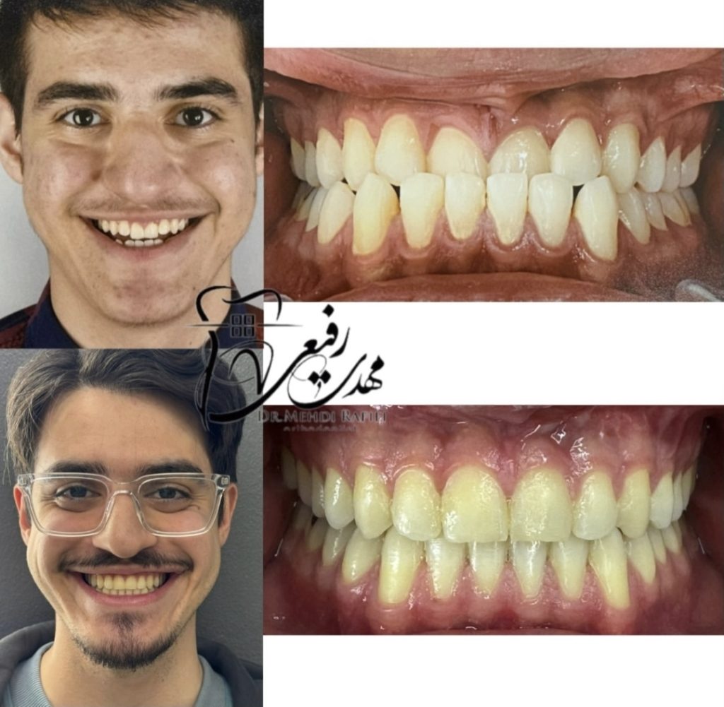 نمونه کار متخصص ارتودنسی اصفهان دکتر مهدی رفیعی