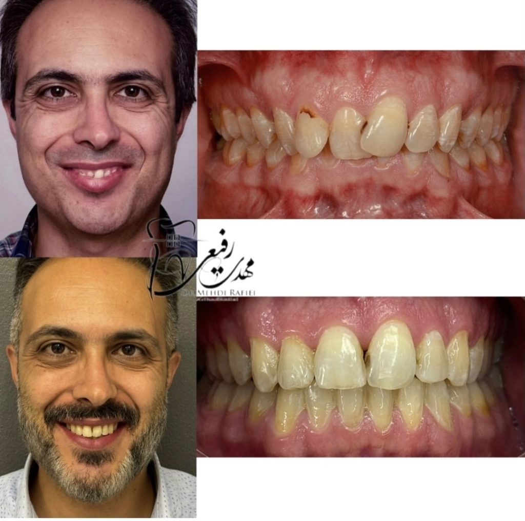 نمونه کار متخصص ارتودنسی اصفهان دکتر مهدی رفیعی