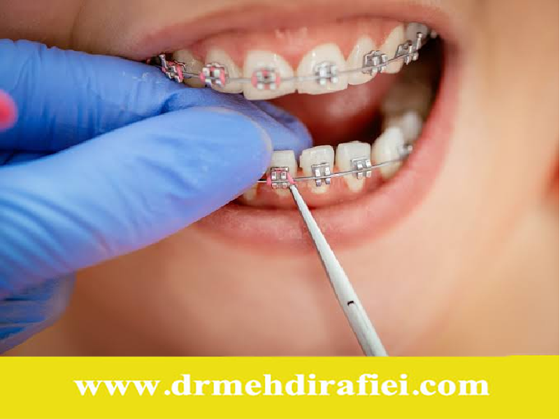 مراحل ارتودنسی