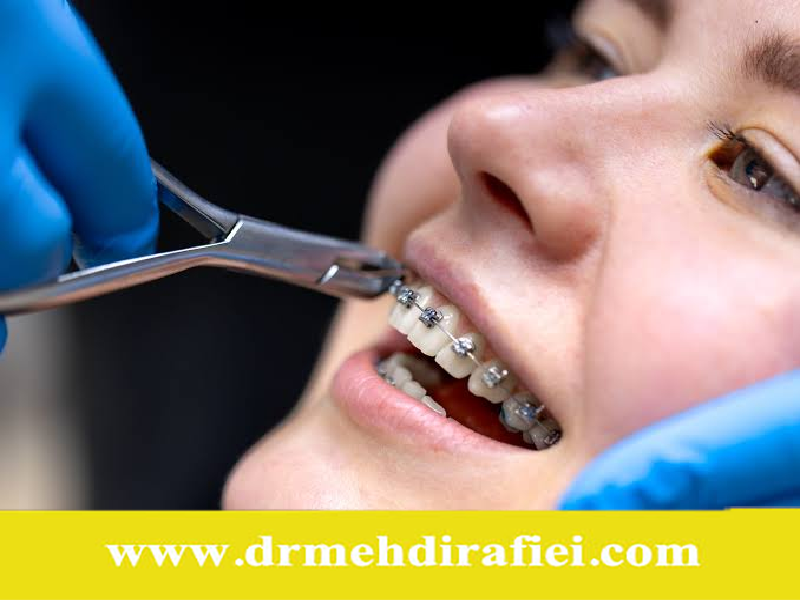 تأثیر عادت‌های بد بر ارتودنسی