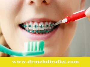 تأثیر عادت‌های بد بر ارتودنسی