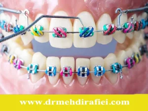 رنگ ارتودنسی متناسب با پوست