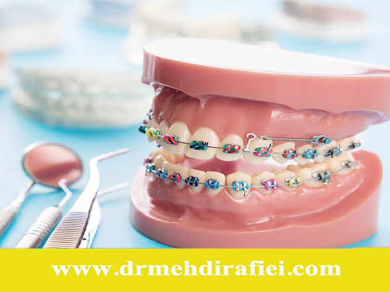 مدت استفاده از ارتودنسی
