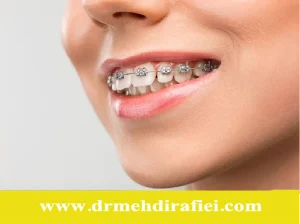 مدت استفاده از ارتودنسی