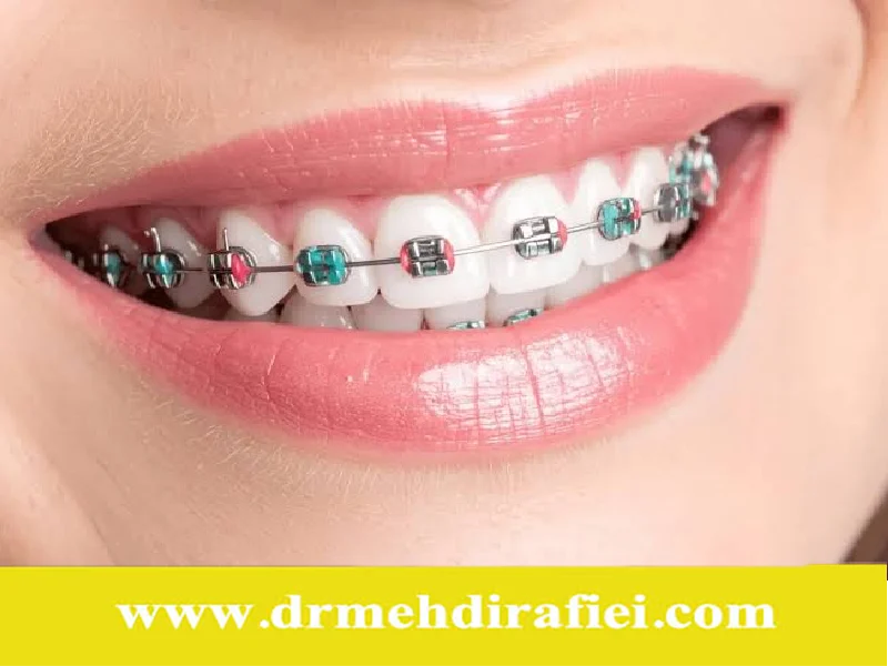 رنگ ارتودنسی متناسب با پوست