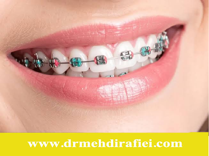 رنگ ارتودنسی متناسب با پوست